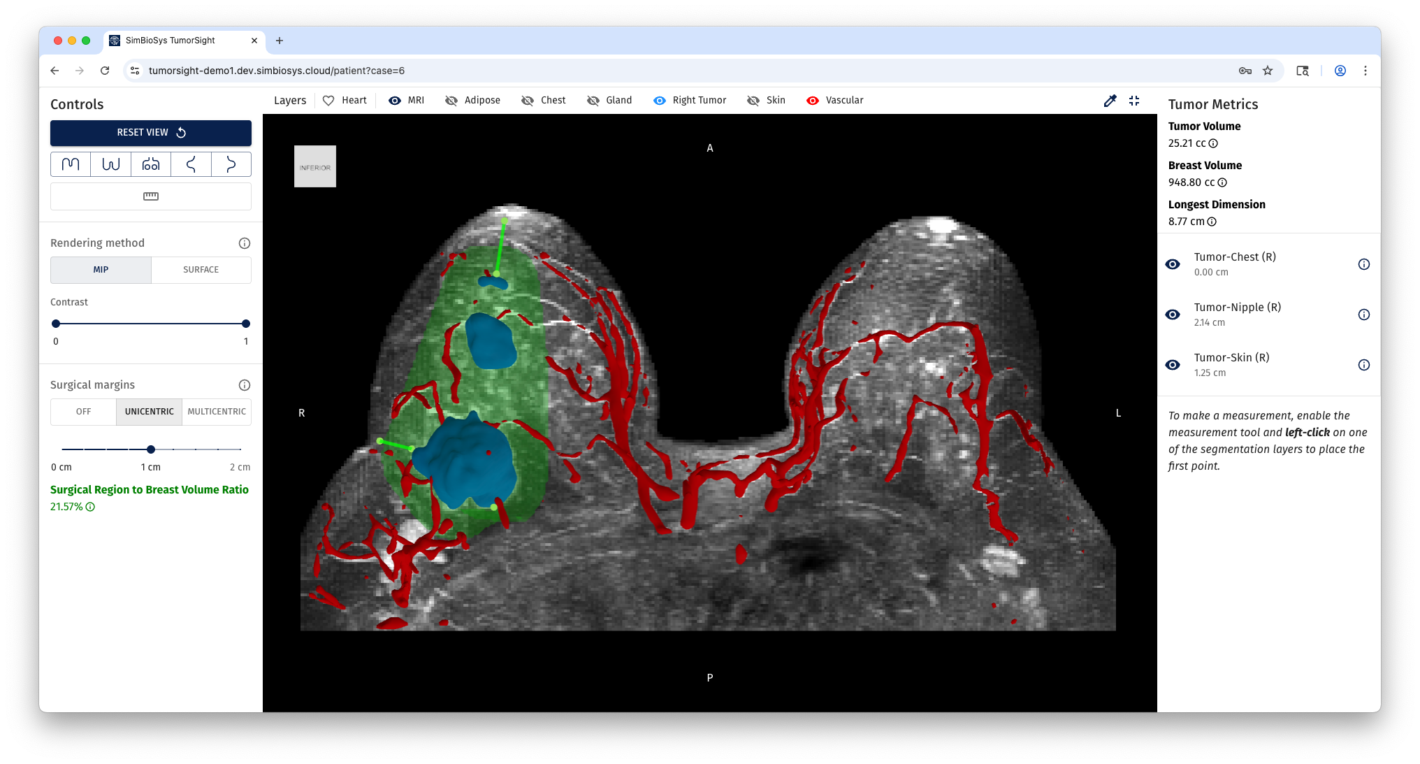 SimBioSys and Ricoh 3D for Healthcare announce strategic alliance